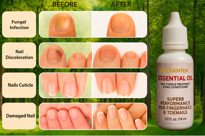 Neogentek Essential Oil Fight Nail Fungus I Made in USA | Pure Natural Ingredients I Ultimate Strength Superb Performance | Promotes Healthy Nail | Renew | Restore Weak & Discolored Nails 14 ML